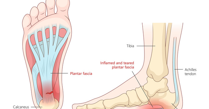 Plantar Fasciitis: Causes, Symptoms, and How Chiropractic Care Can Help 