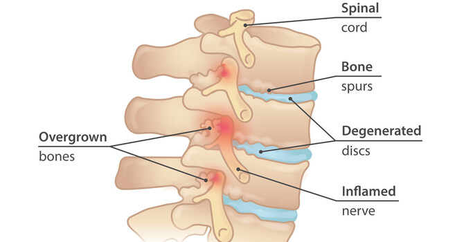 Degenerative Disc Disease: Why This Diagnosis Isn't Always as Bad as It Sounds